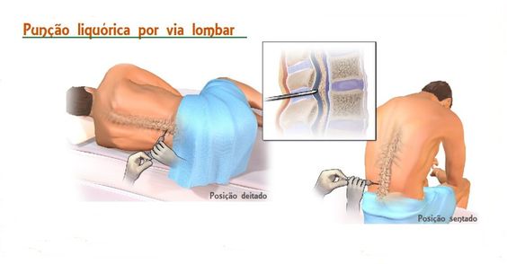 Meningite - como evitar pegar meningite , vacinas de meningite e muitos outros detalhes.
