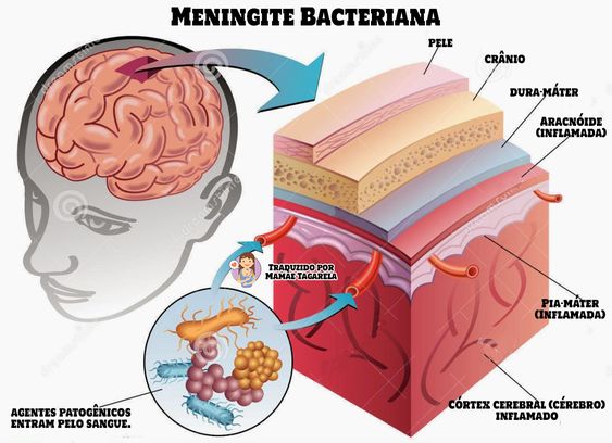 Meningite - como evitar pegar meningite , vacinas de meningite e muitos outros detalhes.