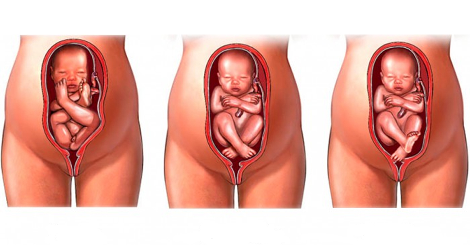 Bebê Pelvico – O que É e O que Fazer