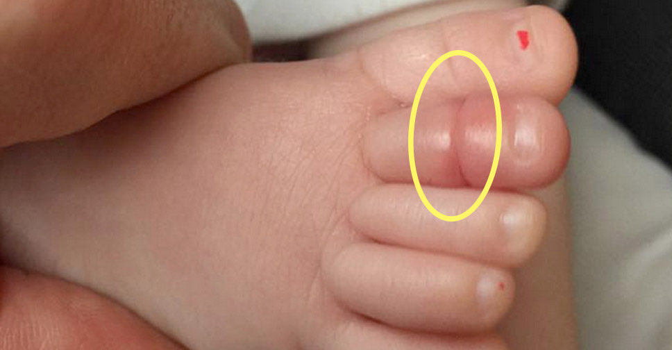 O Que é Síndrome do Torniquete?