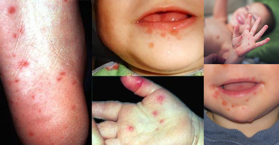 Síndrome Mão-Pé-Boca – Aquele Resumão Que Você Precisava